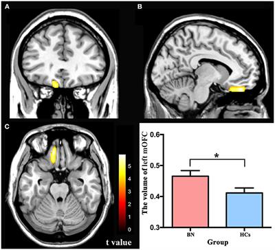 Altered gray matter volume and functional connectivity in medial orbitofrontal cortex of bulimia nervosa patients: A combined VBM and FC study